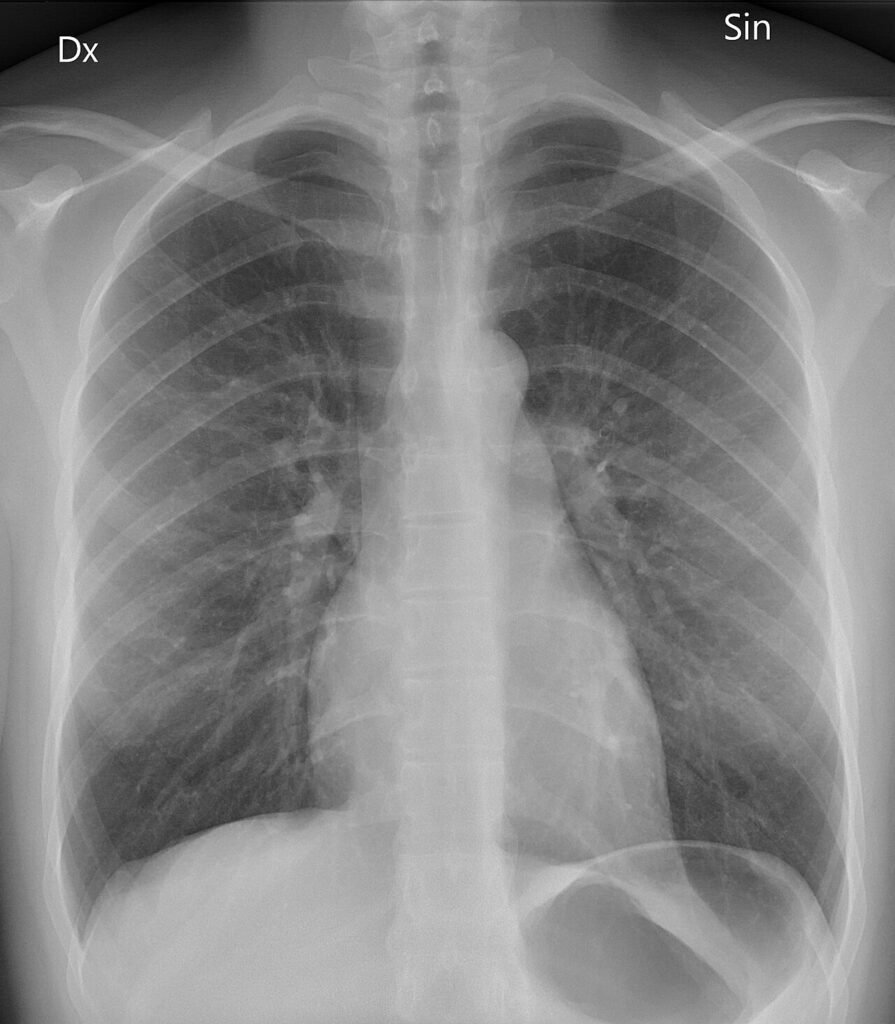 Posteroanterior chest X-ray of the kind taken during the UAE medical fitness test